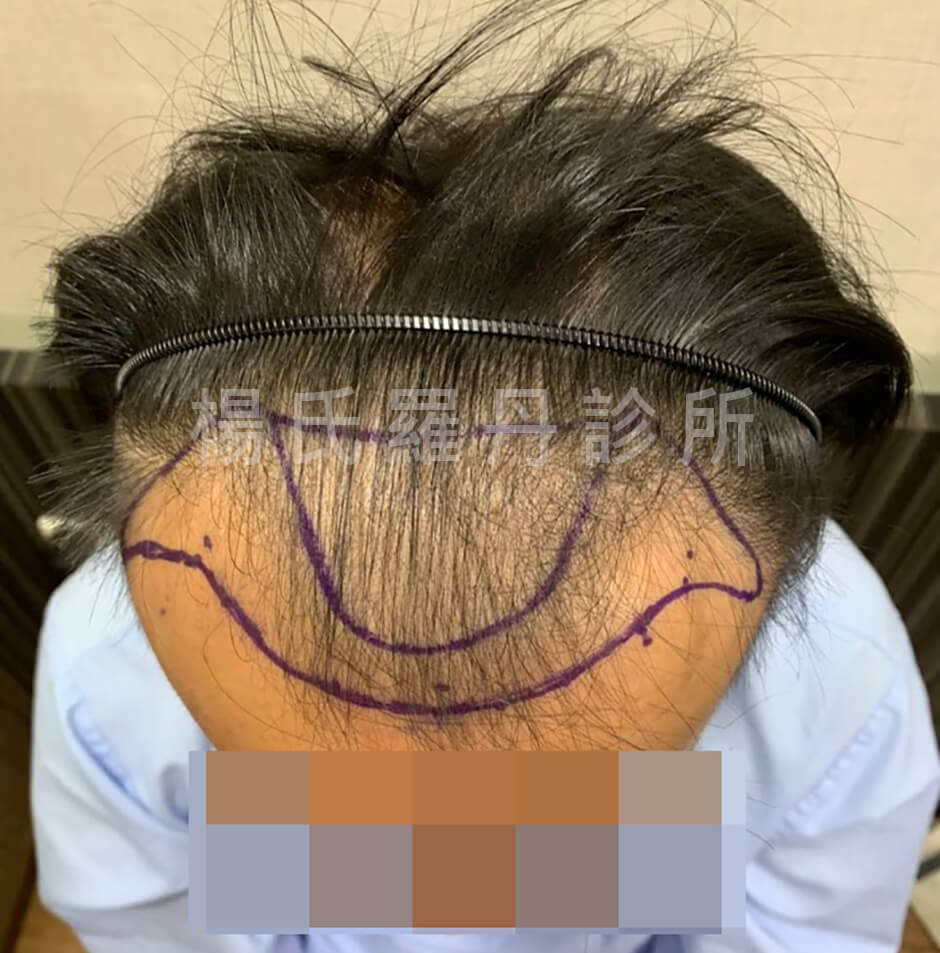 植髮手術 植髮 落髮