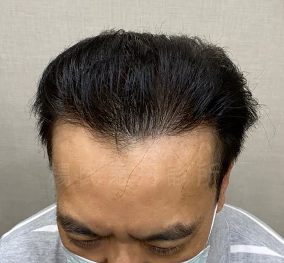 植髮 雄性禿治療