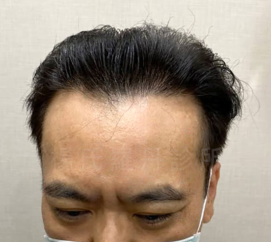 植髮 雄性禿 楊氏羅丹