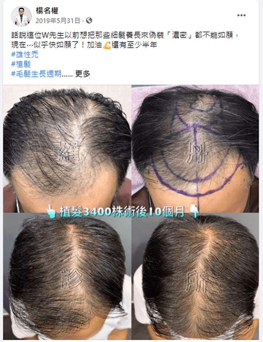 禿頭 生髮 生髮613 植髮效果 禿髮 植髮