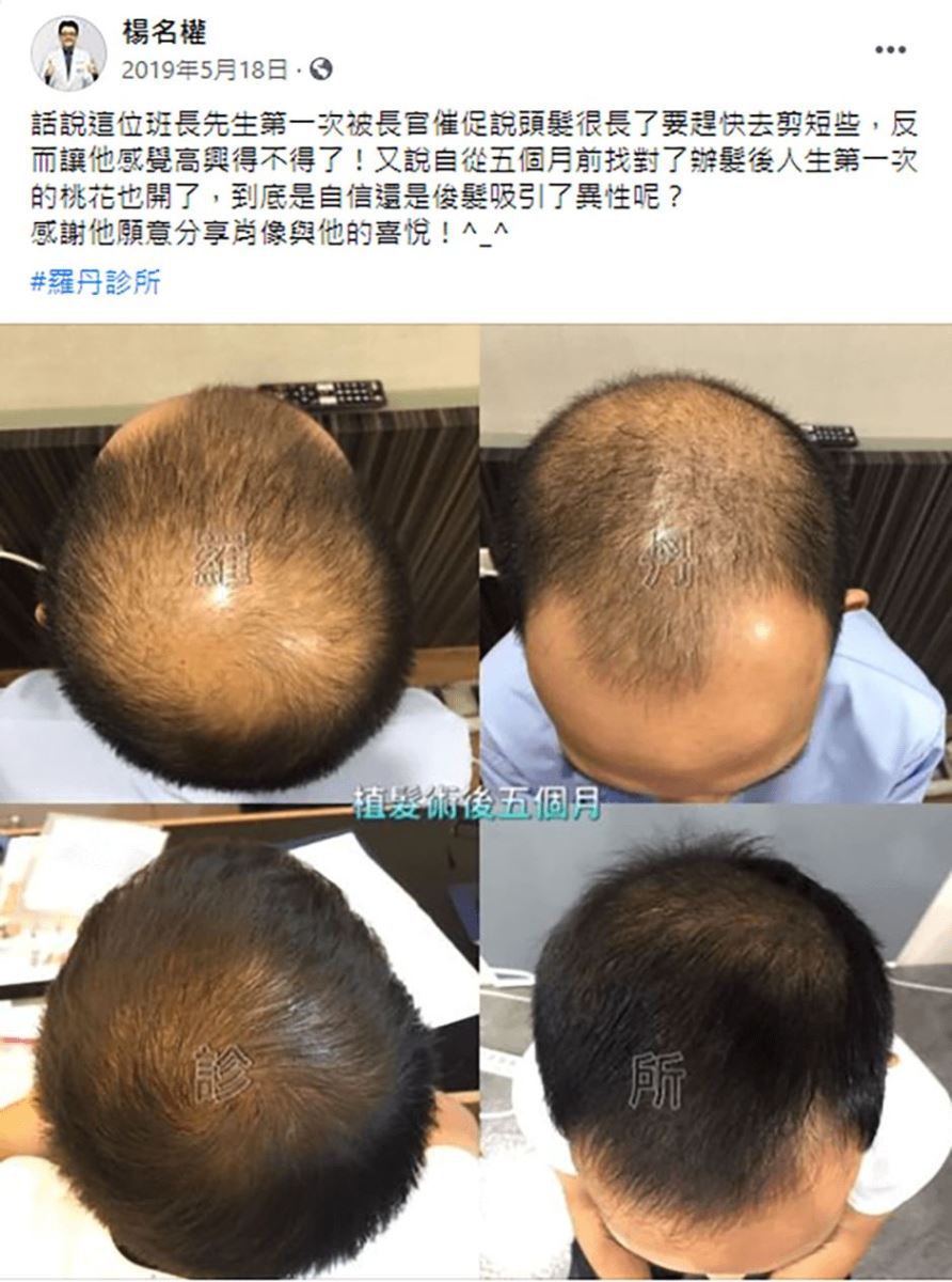 植髮,禿頭,掉髮,楊氏羅丹,植髮效果 生髮613