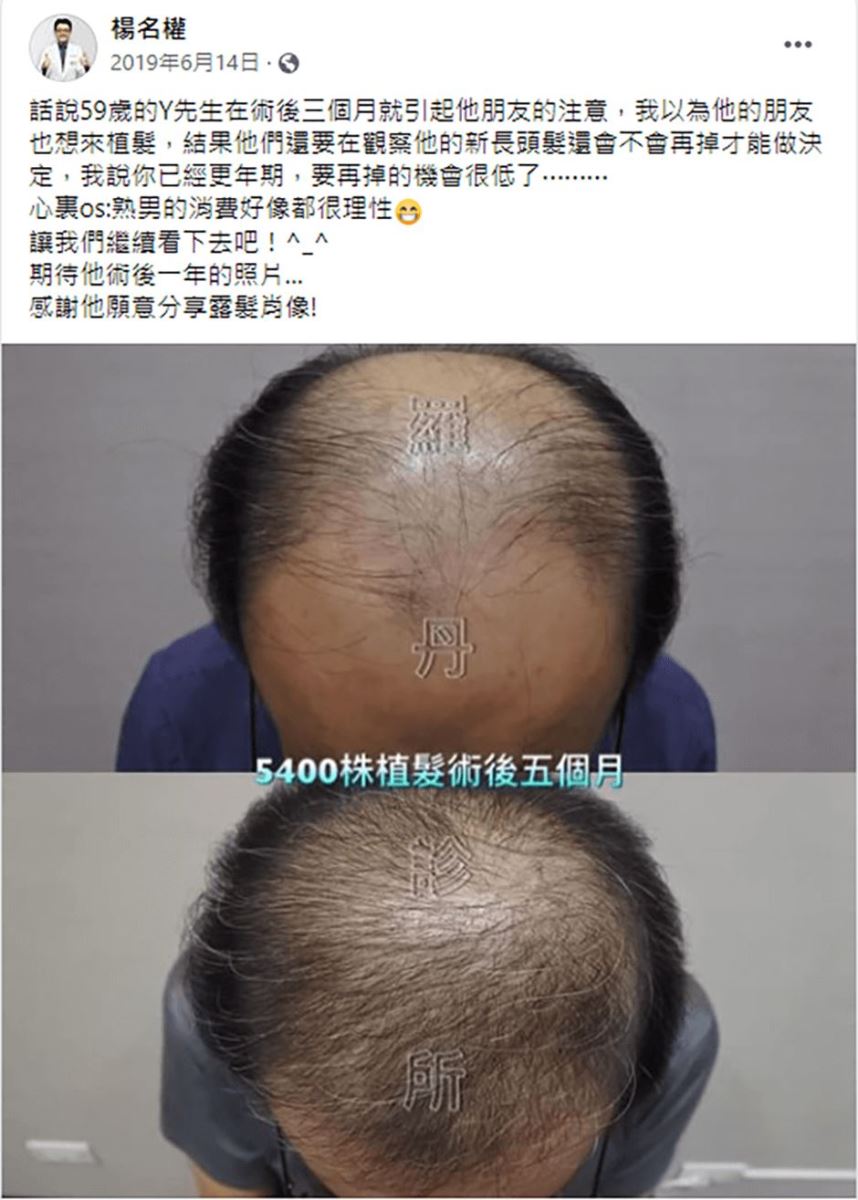 植髮,禿頭,掉髮 生髮 植髮效果 生髮613