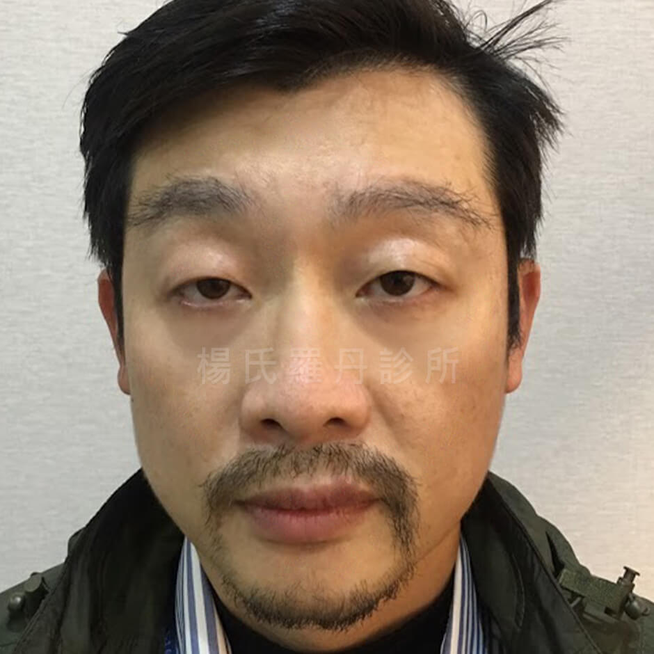 植髮 ARTAS 植髮診所 