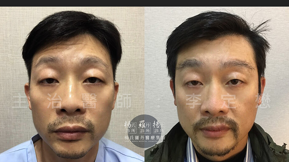 植眉 楊氏羅丹 植髮診所