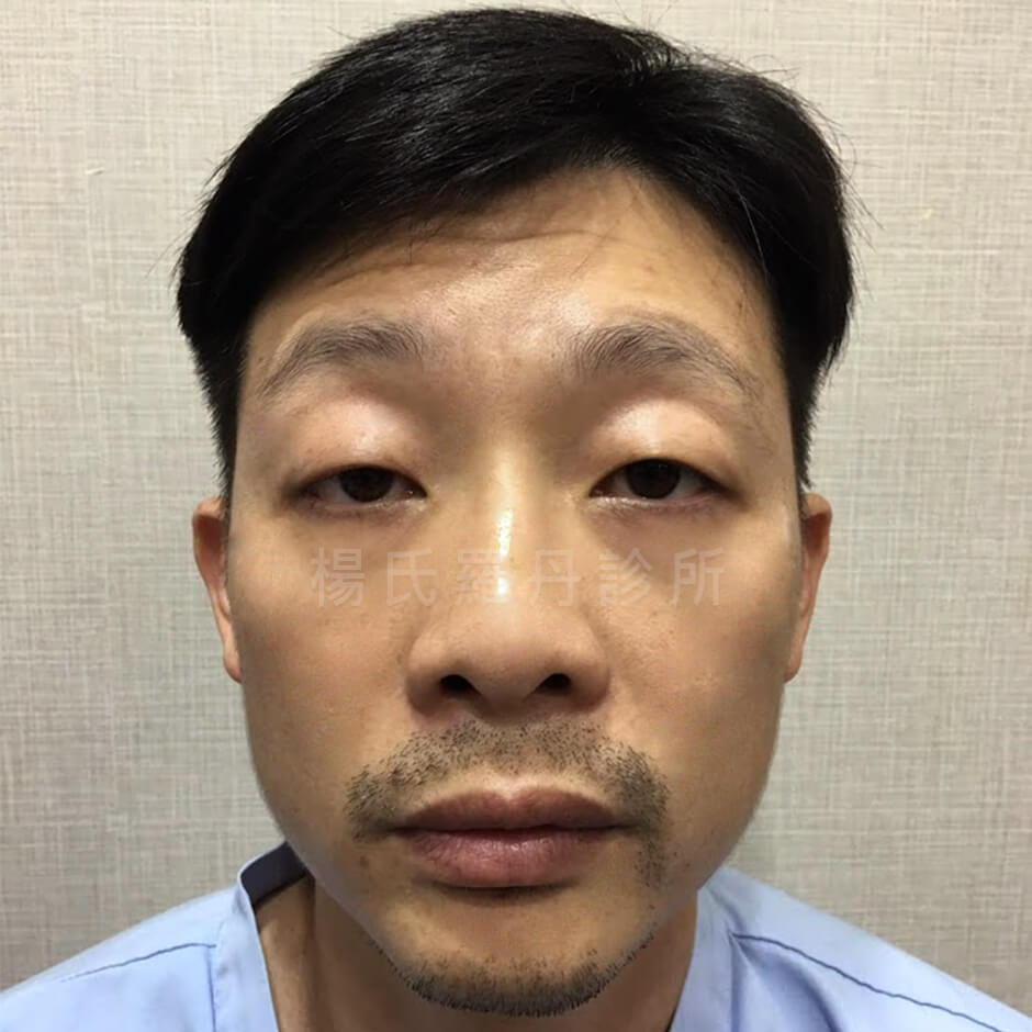 植髮 植鬍  植眉