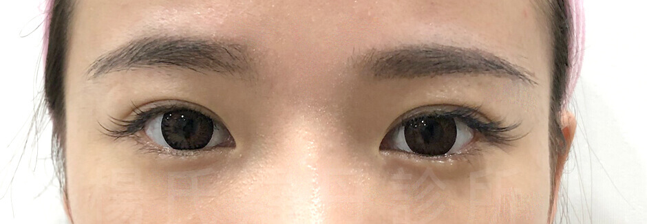 釘書機雙眼皮 雙眼皮手術 醫學美容