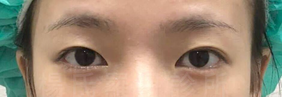 雙眼皮,醫學美容