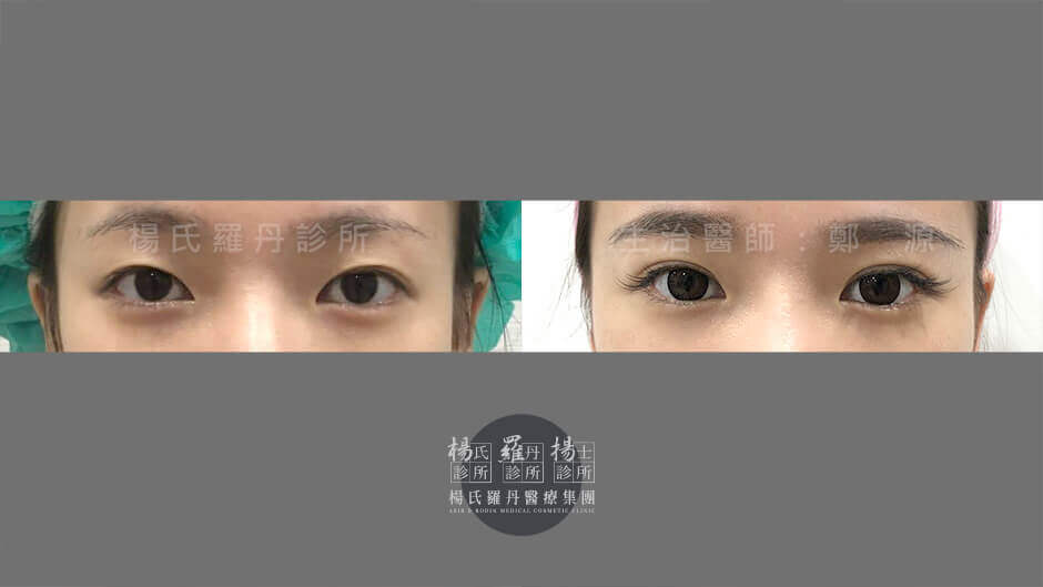 雙眼皮 腫泡眼 醫學美容