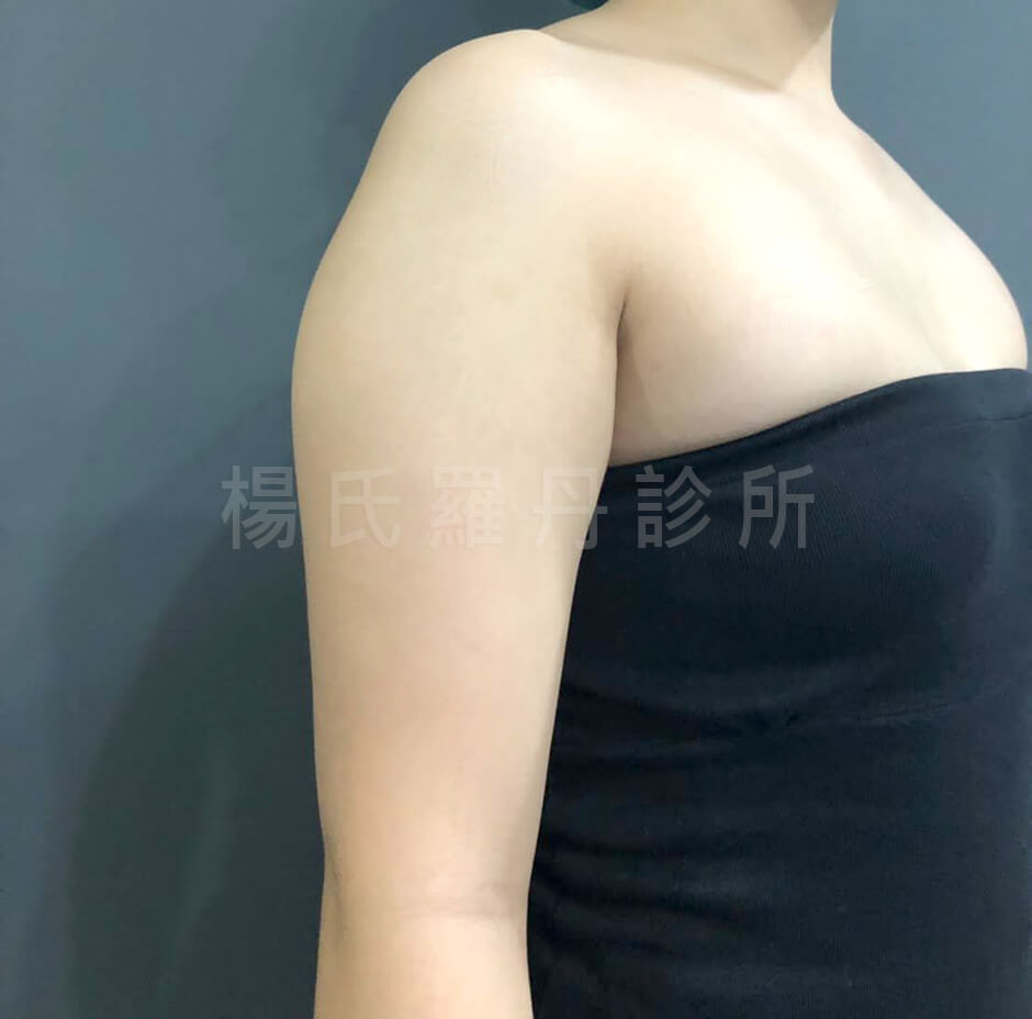 減脂手術 雷射減脂 手臂