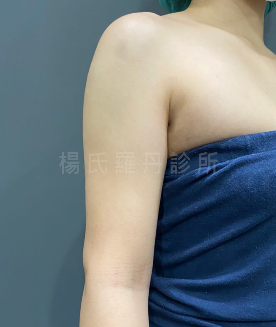 瘦手臂 掰掰袖 雷射減脂手術