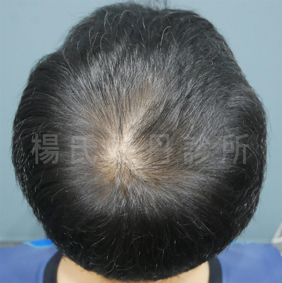 雄性禿 ARTAS植髮  落髮