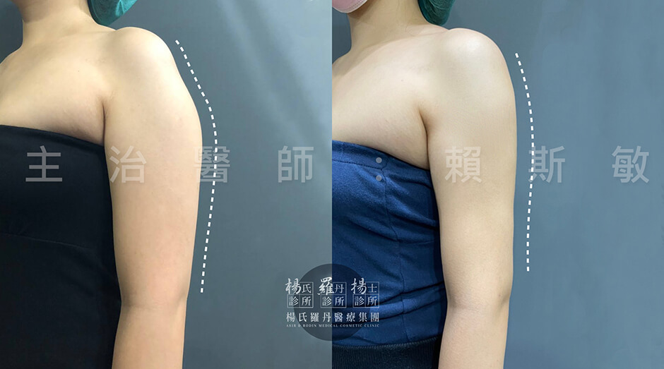 雷射減脂 減脂手術 瘦手臂