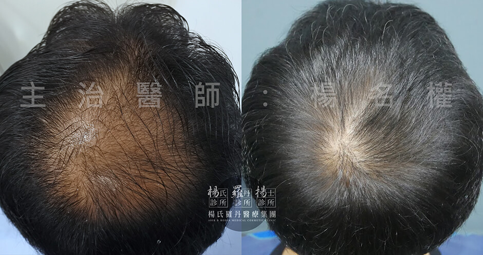 ARTAS植髮 落髮 植髮手術