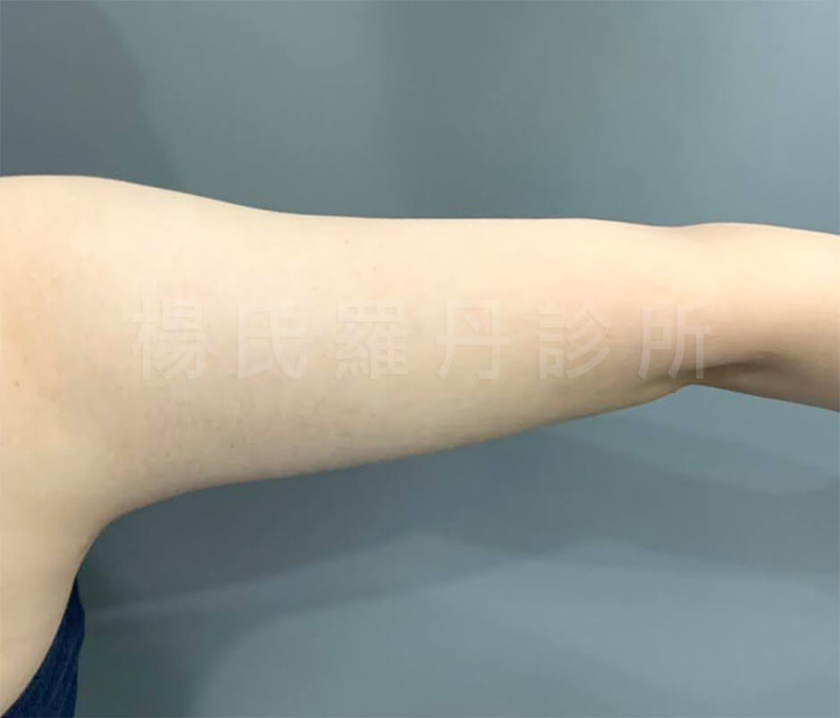 瘦手臂 雷射減脂手術