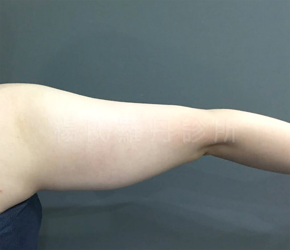 手臂 贅肉 雷射減脂