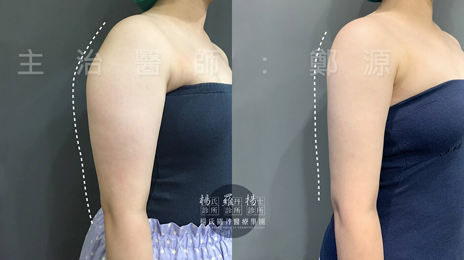 手臂 贅肉 雷射減脂