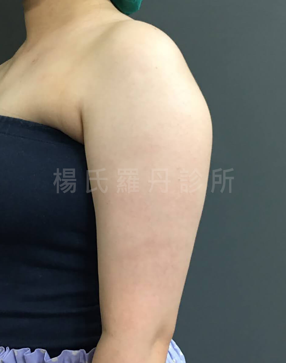 瘦手臂效果 雷射減脂手術