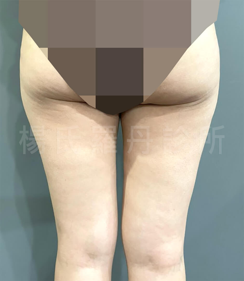 雷射減脂  瘦大腿