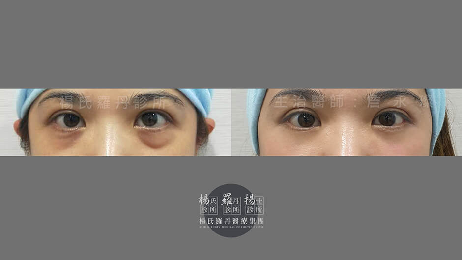 眼袋淚溝 眼袋手術 醫學美容