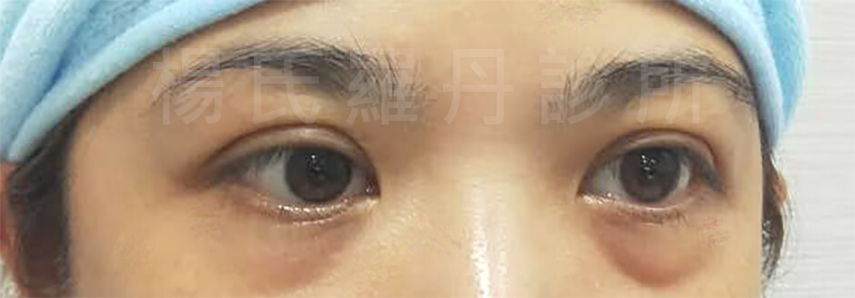 眼袋 眼袋手術 楊氏羅丹