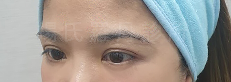 眼袋手術  醫學美容