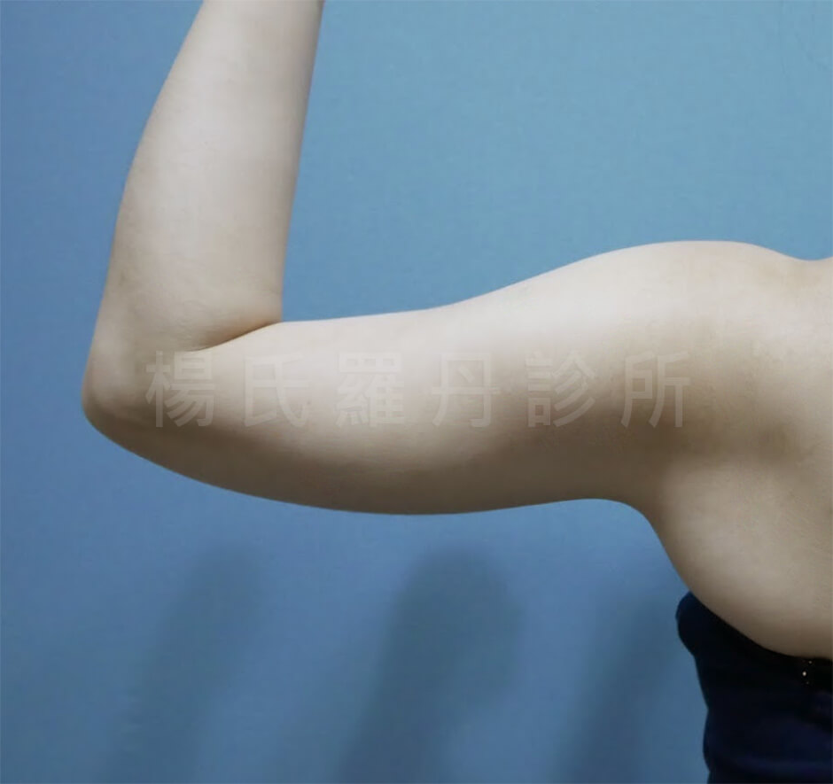 雷射減脂 手臂 瘦手臂