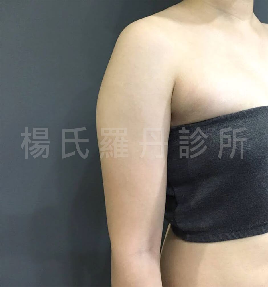 雷射減脂  蝴蝶袖