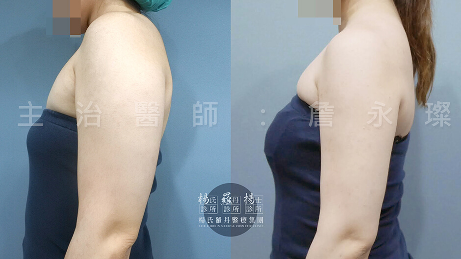 瘦手臂 贅肉 雷射減脂