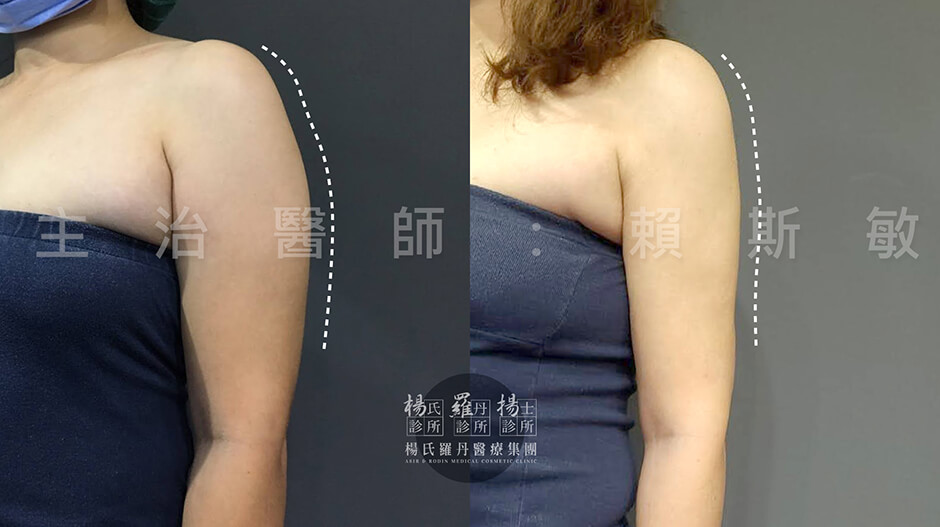 雷射減脂手術  瘦手臂 贅肉