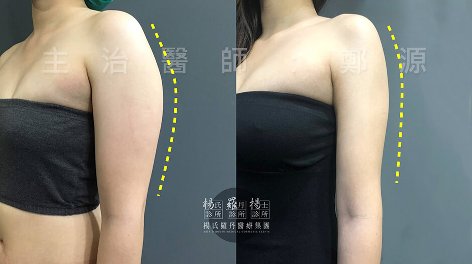 瘦手臂  雷射減脂 楊氏羅丹