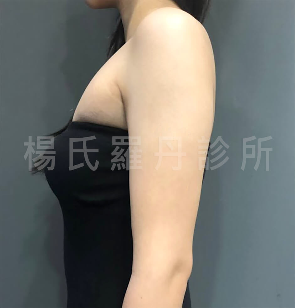 手臂 蝴蝶袖 楊氏羅丹