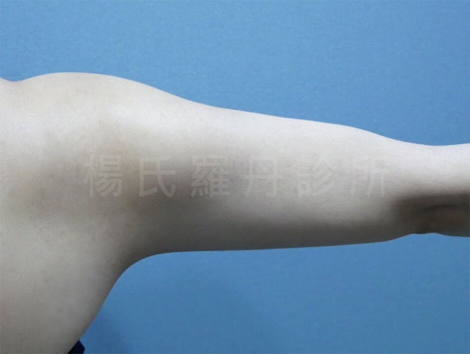 蝴蝶袖 雷射減脂