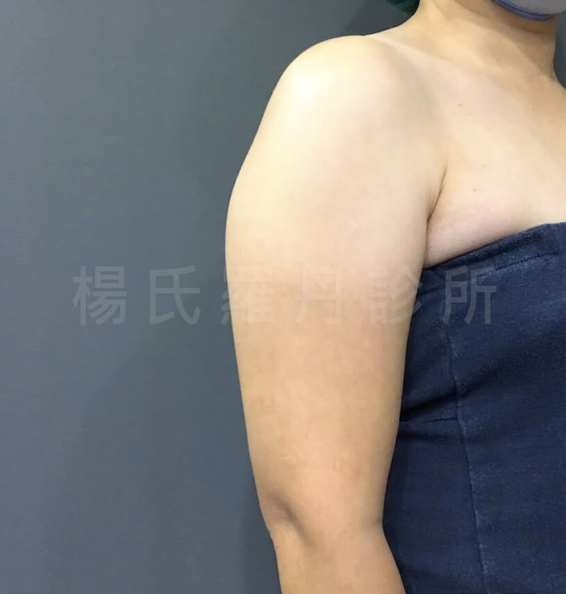 雷射減脂 雷射減脂效果 