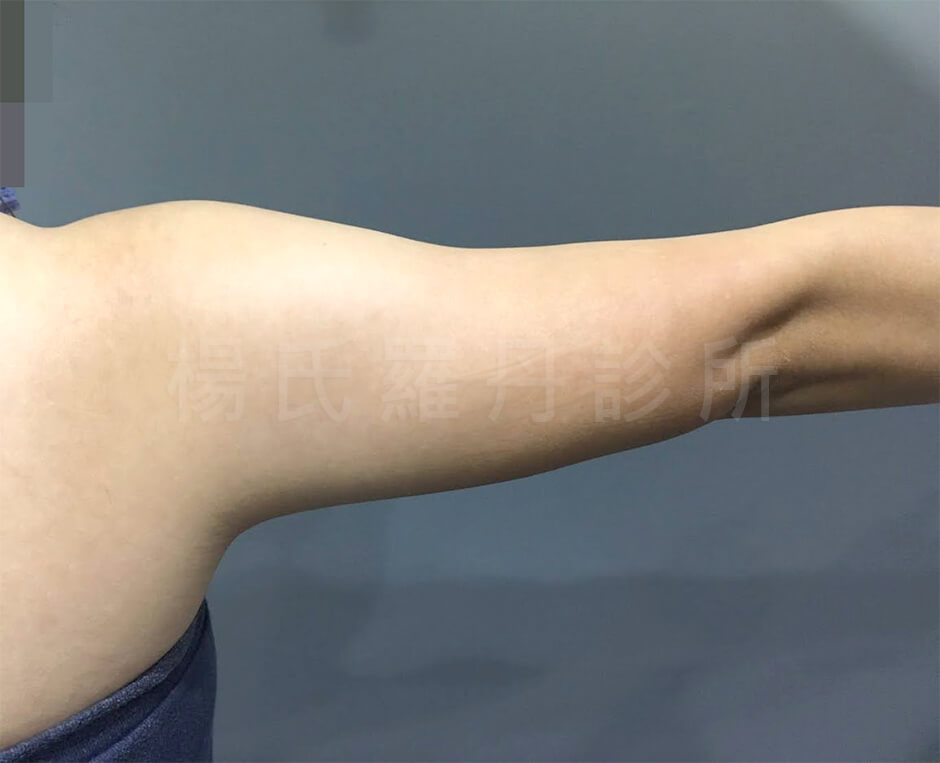 手臂 瘦手臂 雷射減脂
