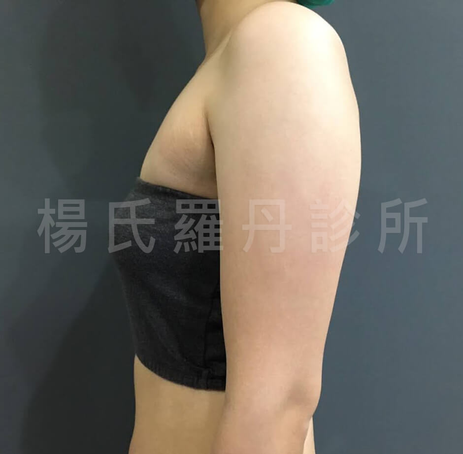 楊氏羅丹 瘦手臂