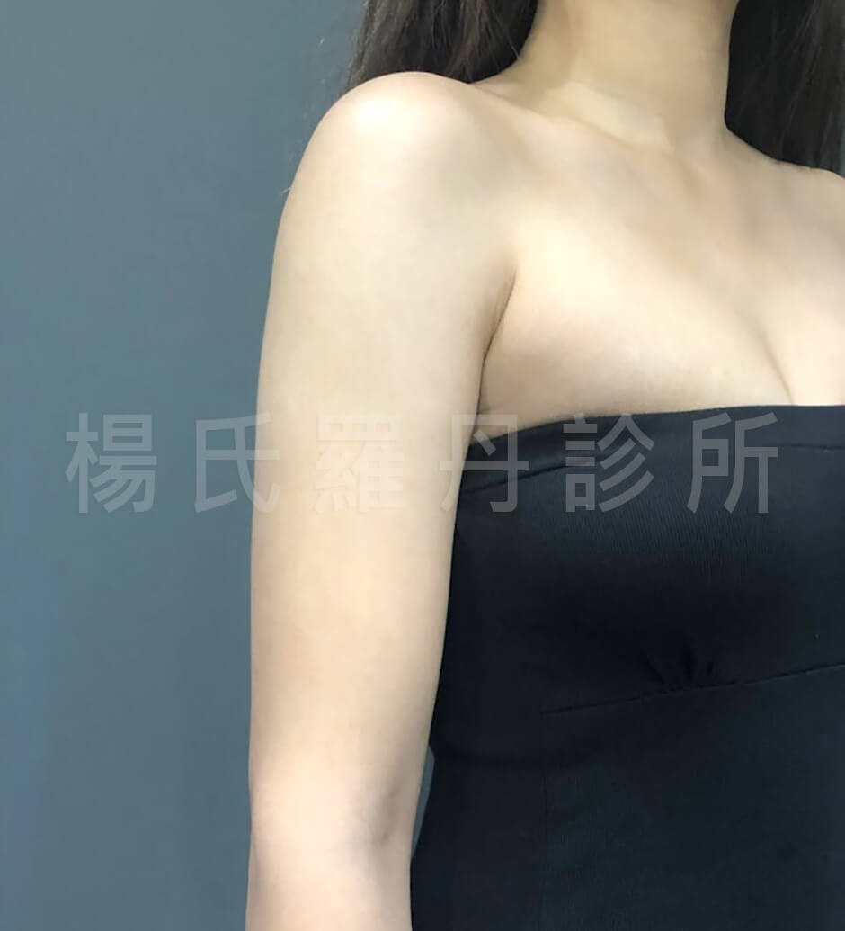 贅肉  瘦手臂  手臂