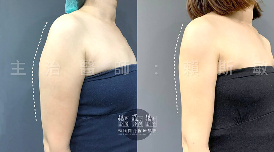 贅肉  雷射減脂  掰掰袖