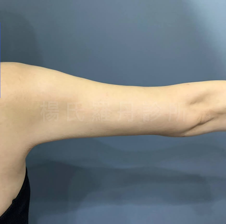 雷射減脂  瘦手臂 