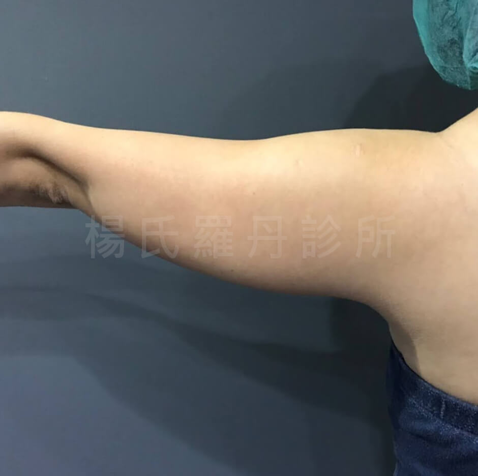 瘦手臂 手臂 雷射減脂