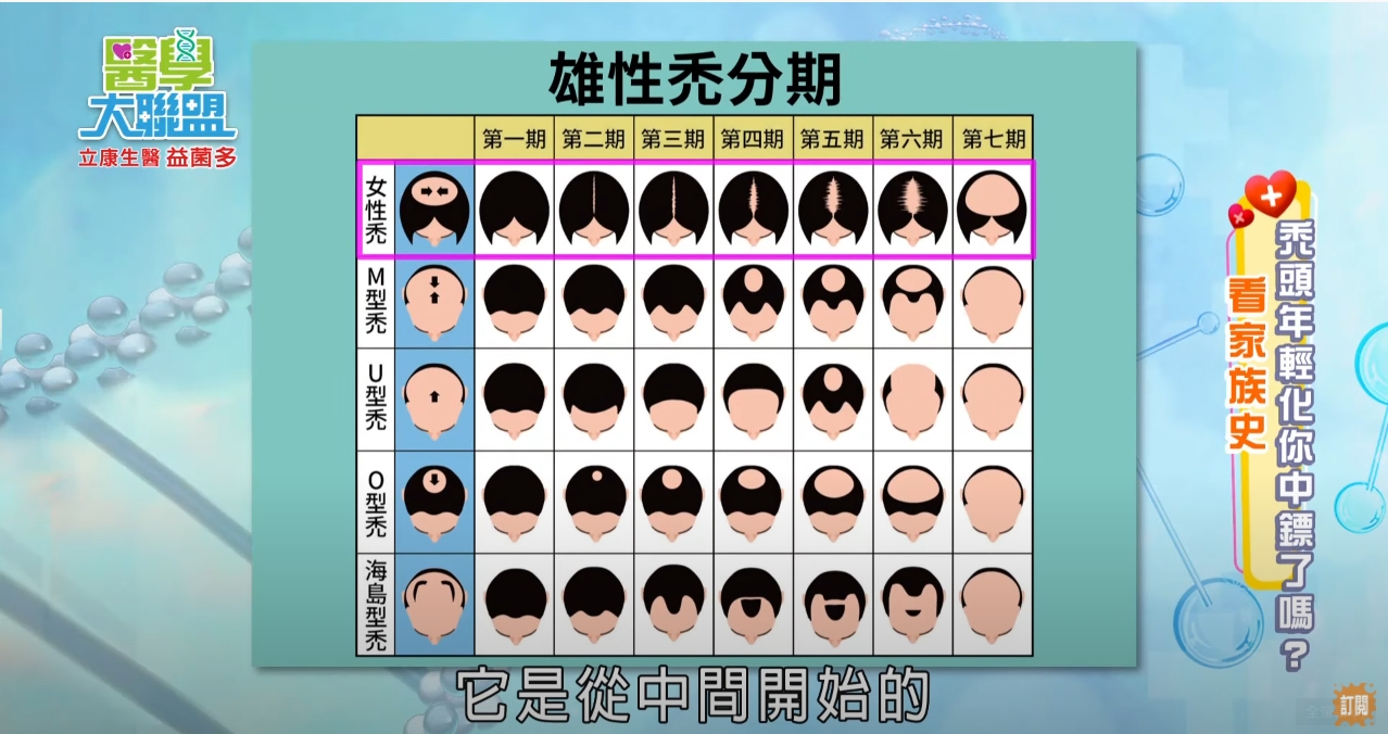 雄性禿 禿頭問題 禿頭 植髮