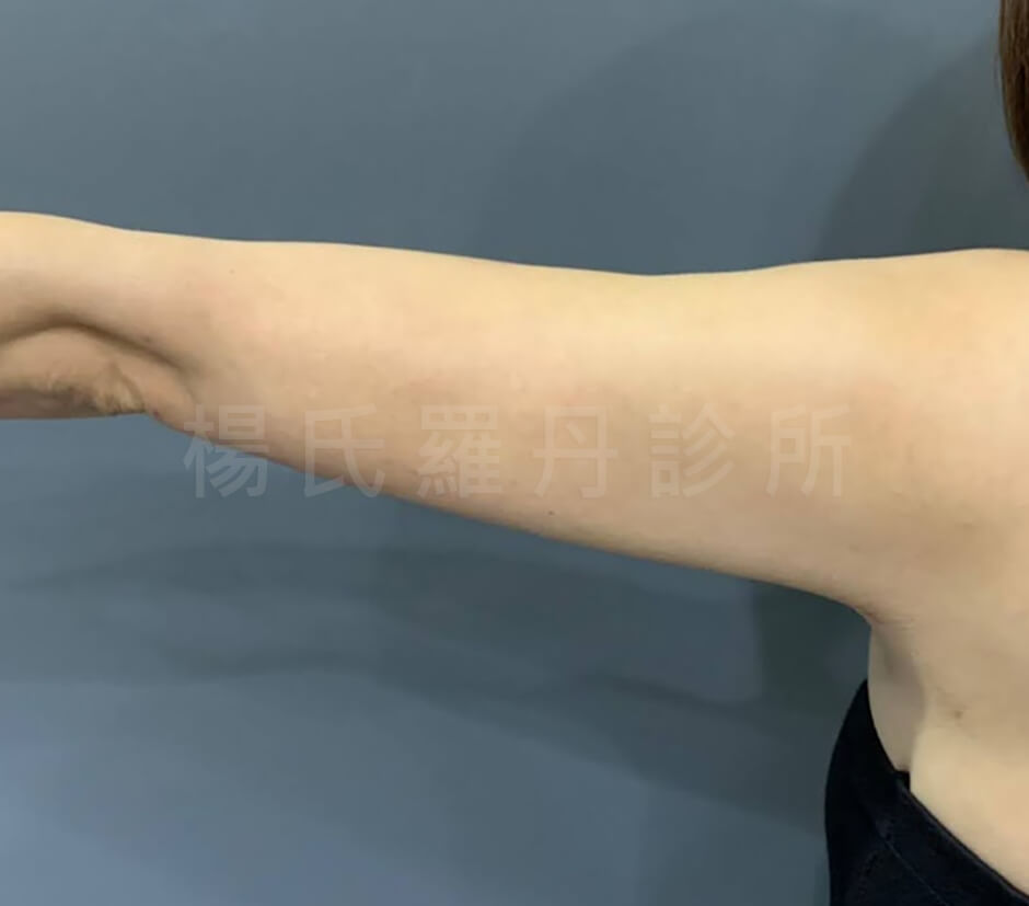 掰掰袖  瘦手臂  雷射減脂