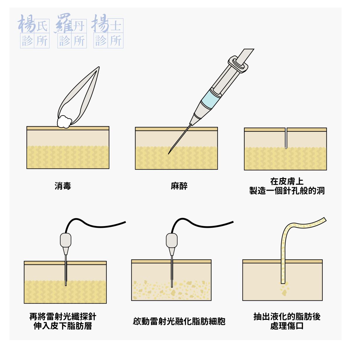 手臂 雷射減脂 雕塑