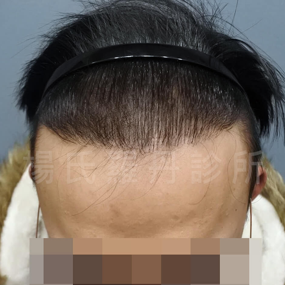 掉髮 植髮手術 植髮