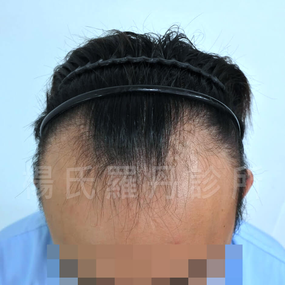 禿頭 掉髮 植髮 生髮