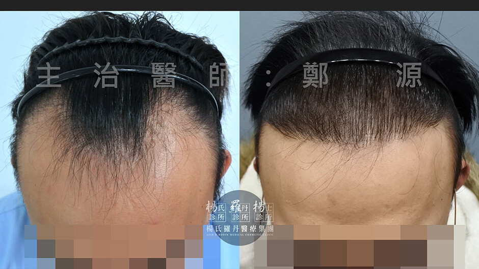 植髮 禿頭 掉髮