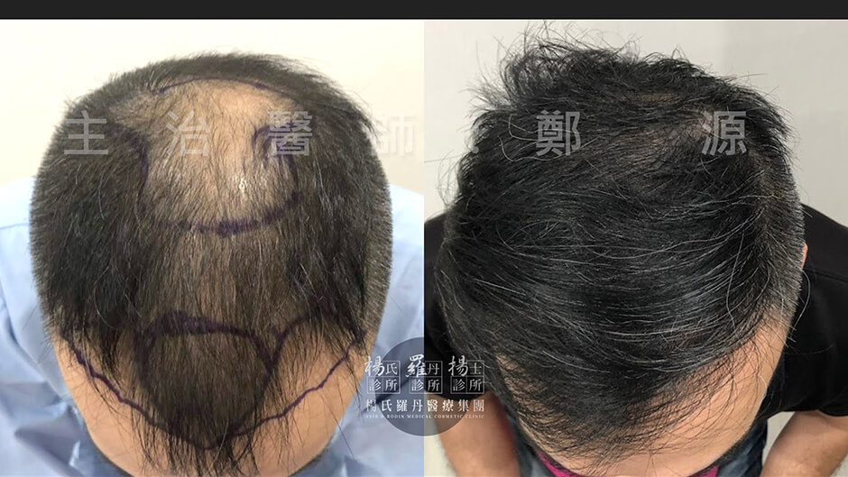 禿頭治療  禿頭  植髮
