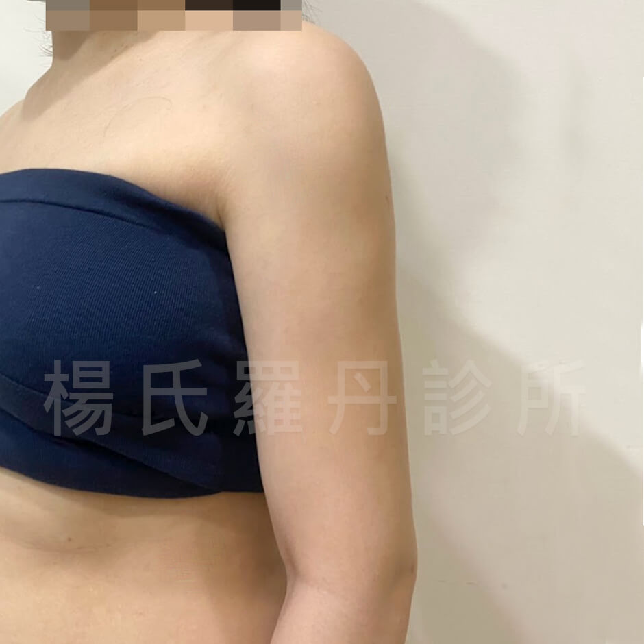 贅肉  瘦手臂