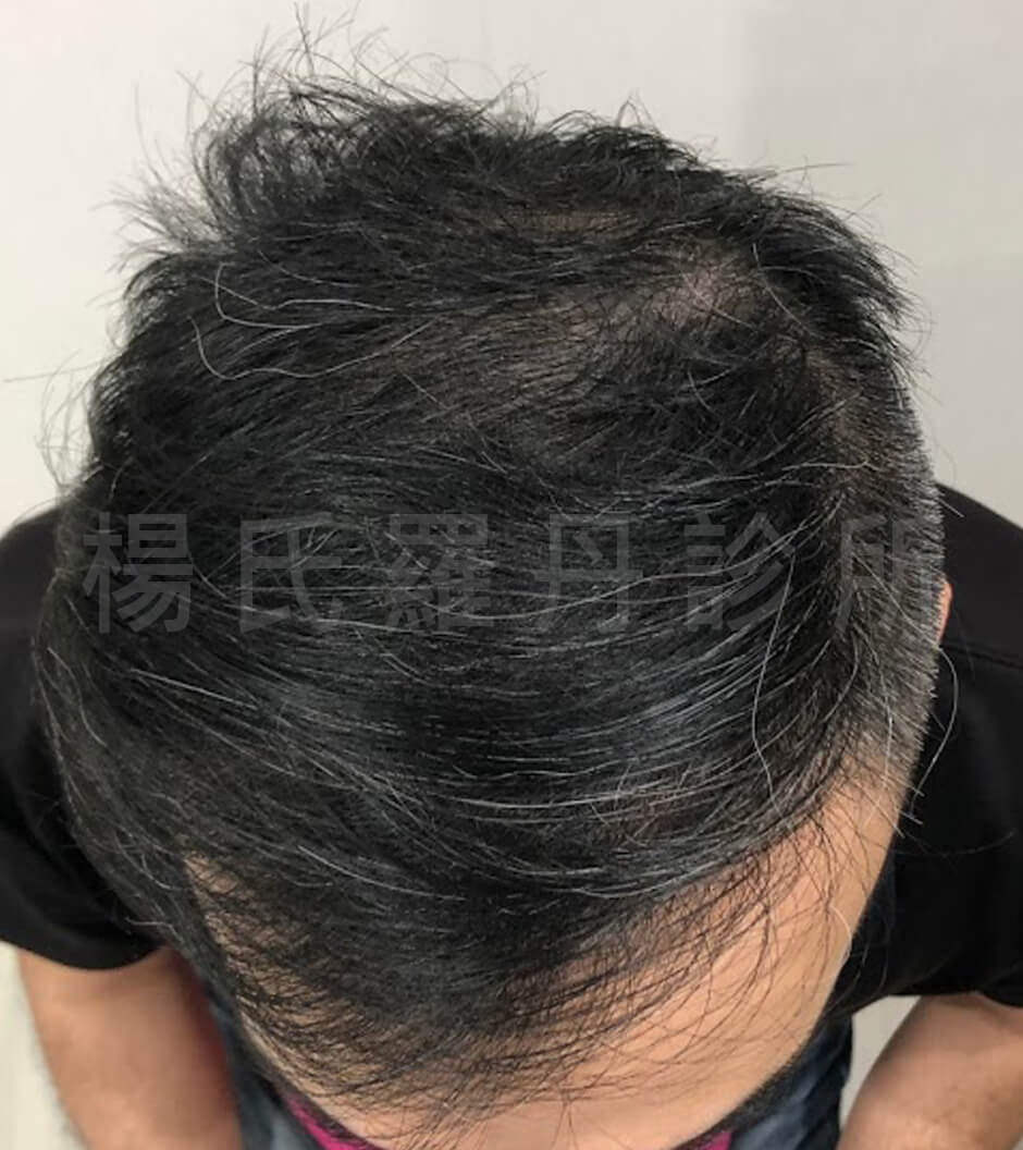 植髮  禿頭  掉髮