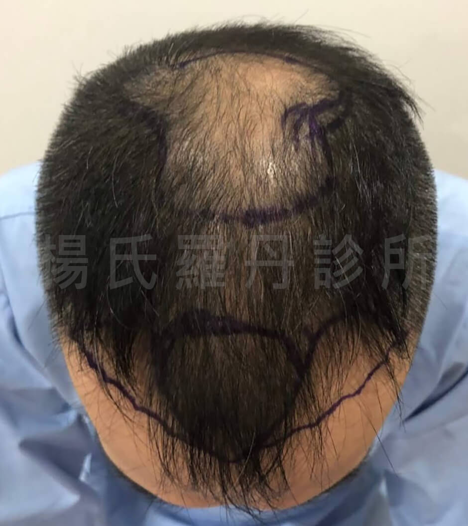 掉髮 禿頭  ARTAS