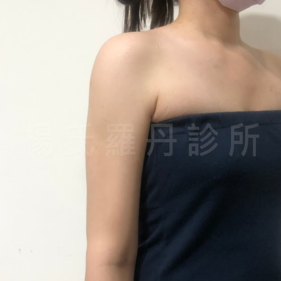 雷射減脂手術 瘦手臂